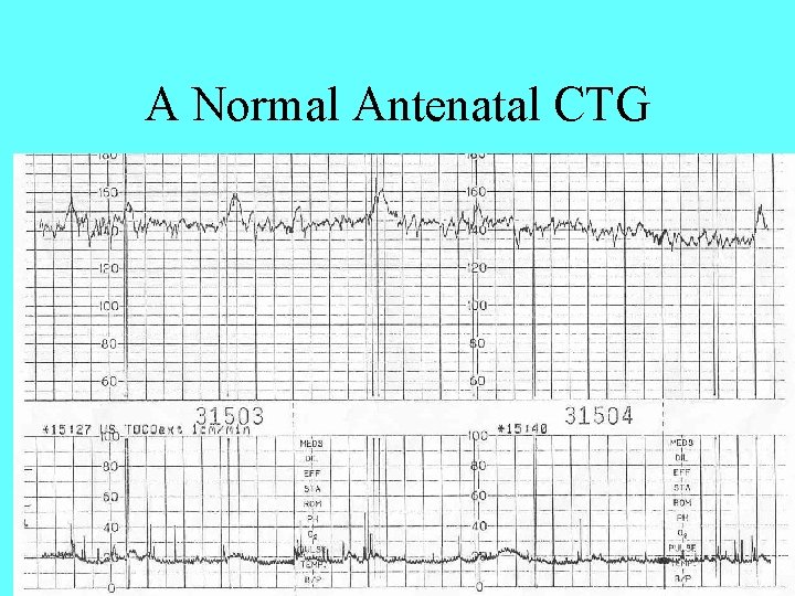 A Normal Antenatal CTG 