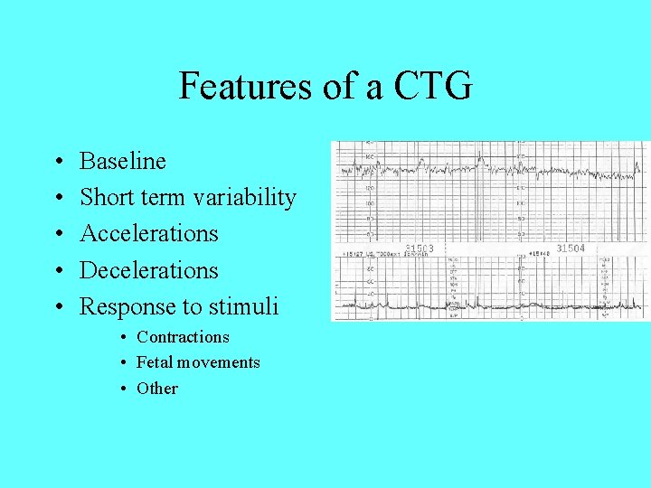 Features of a CTG • • • Baseline Short term variability Accelerations Decelerations Response