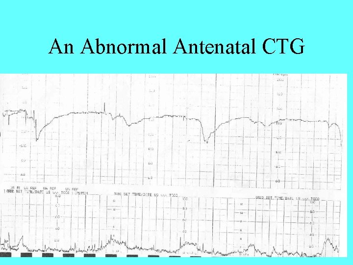 An Abnormal Antenatal CTG 