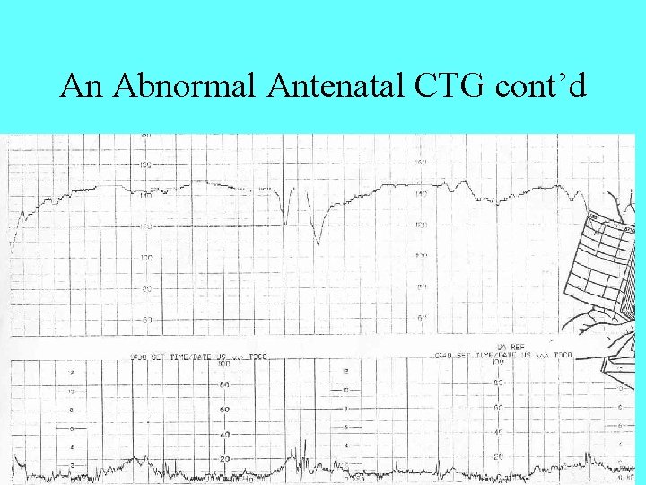 An Abnormal Antenatal CTG cont’d 