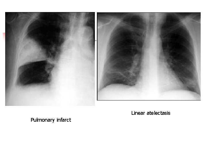 Linear atelectasis Pulmonary infarct 