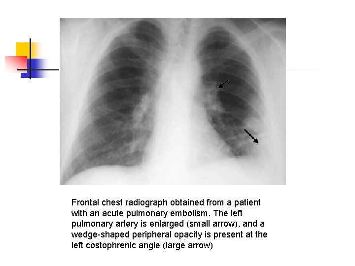 Frontal chest radiograph obtained from a patient with an acute pulmonary embolism. The left