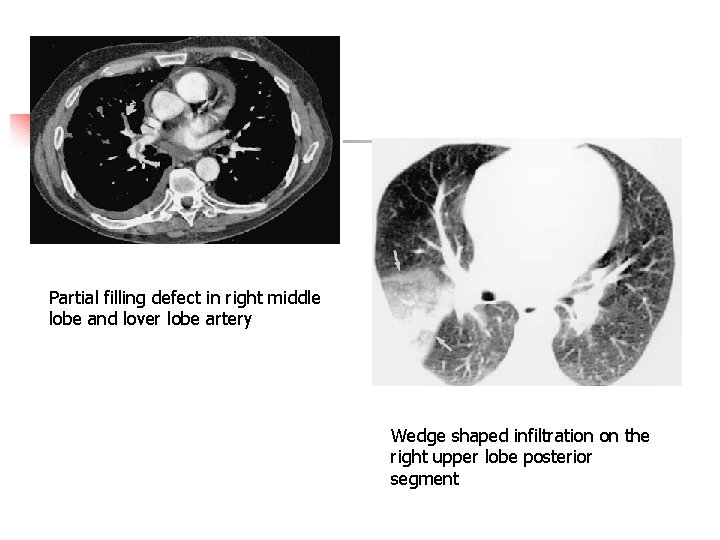 Partial filling defect in right middle lobe and lover lobe artery Wedge shaped infiltration
