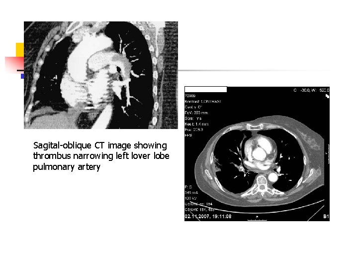 Sagital-oblique CT image showing thrombus narrowing left lover lobe pulmonary artery 