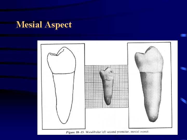 Mesial Aspect Mesial Aspect