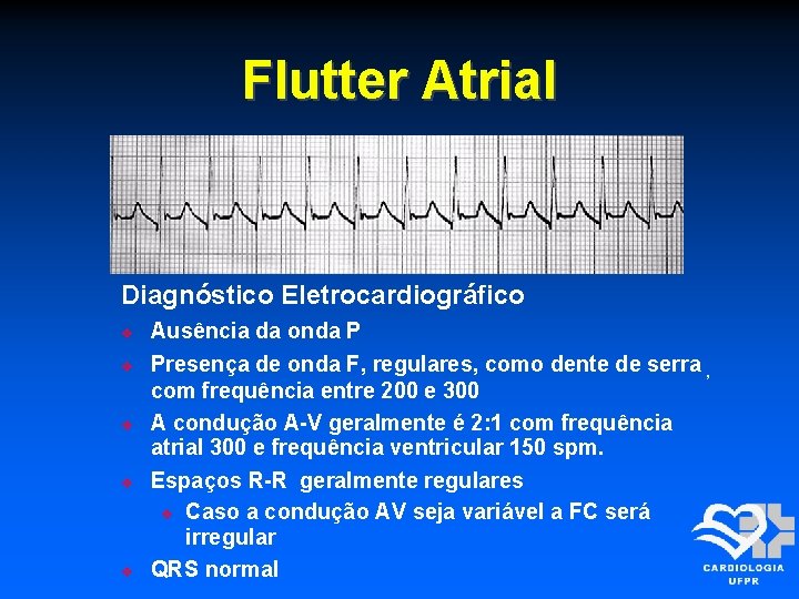 Flutter Atrial Diagnóstico Eletrocardiográfico Ausência da onda P Presença de onda F, regulares, como