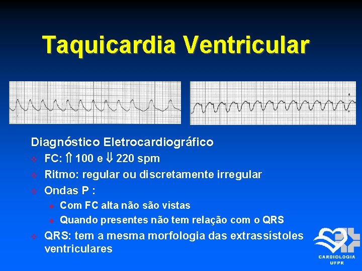 Taquicardia Ventricular Diagnóstico Eletrocardiográfico FC: 100 e 220 spm Ritmo: regular ou discretamente irregular