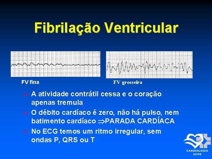 Fibrilação Ventricular FV fina FV grosseira A atividade contrátil cessa e o coração apenas