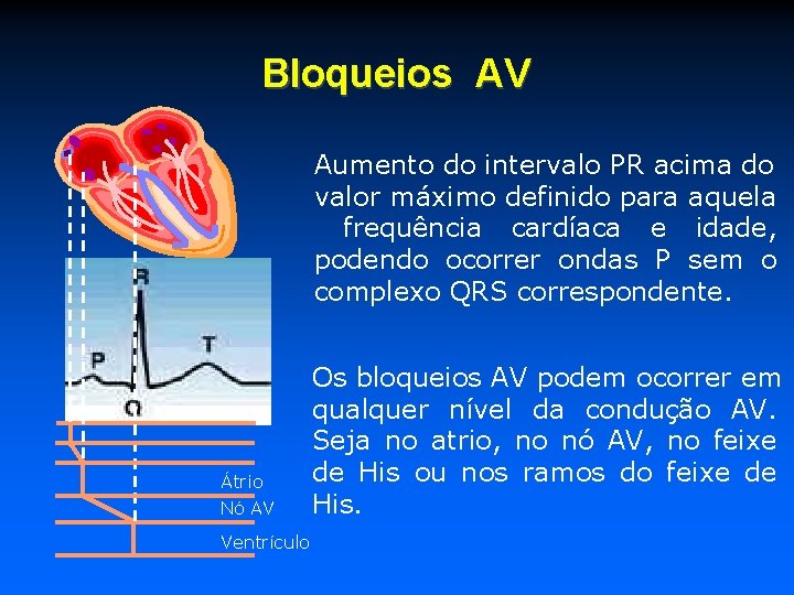 Bloqueios AV Aumento do intervalo PR acima do valor máximo definido para aquela frequência