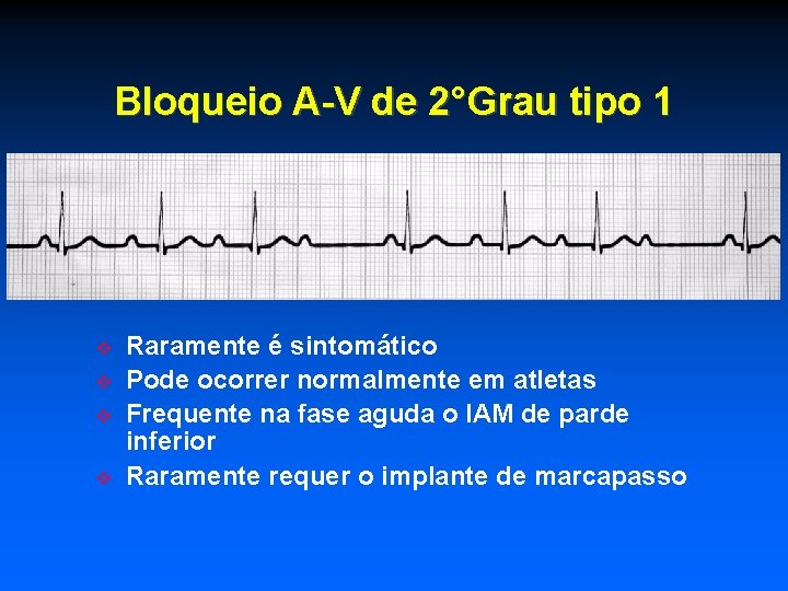 Bloqueio A-V de 2°Grau tipo 1 Raramente é sintomático Pode ocorrer normalmente em atletas