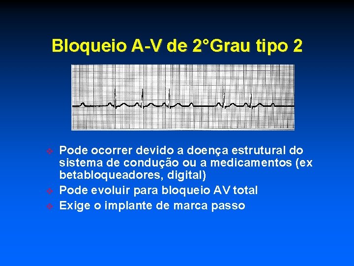 Bloqueio A-V de 2°Grau tipo 2 Pode ocorrer devido a doença estrutural do sistema