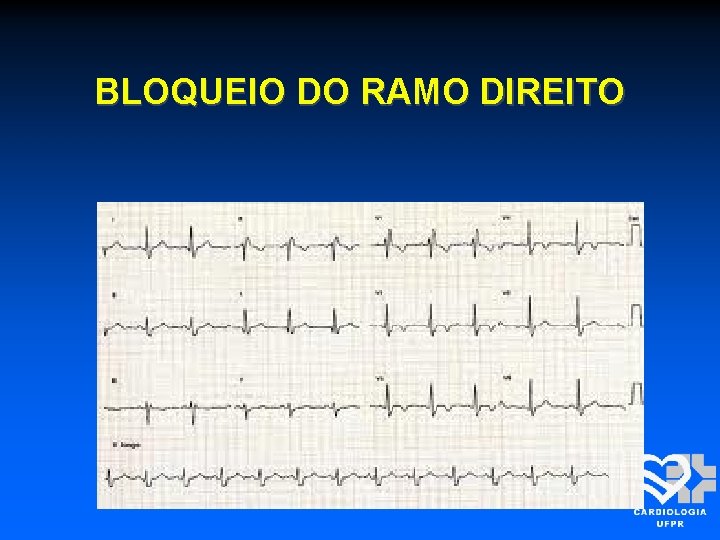 BLOQUEIO DO RAMO DIREITO 