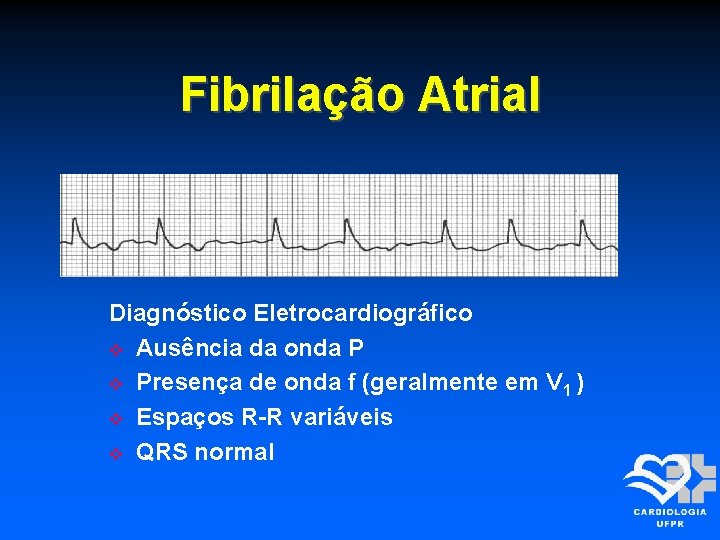 Fibrilação Atrial Diagnóstico Eletrocardiográfico Ausência da onda P Presença de onda f (geralmente em