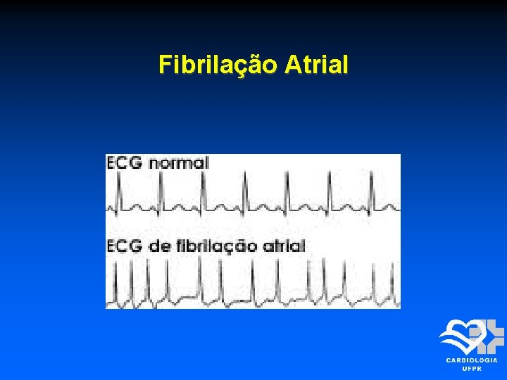 Fibrilação Atrial 