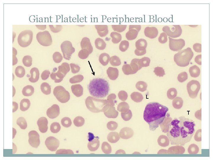 Giant Platelet in Peripheral Blood L T 