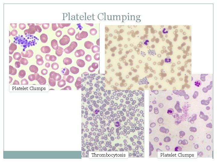 Platelet Clumping Platelet Clumps Thrombocytosis Platelet Clumps 