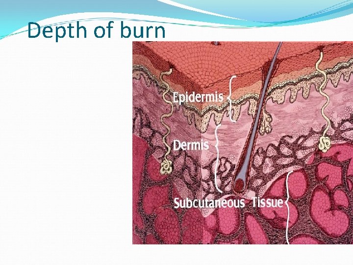 Depth of burn Partial thickness burn involves epiderm Deep partial thickness involves derm Full