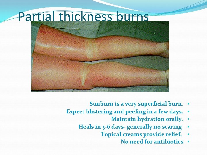 Partial thickness burns Sunburn is a very superficial burn. Expect blistering and peeling in