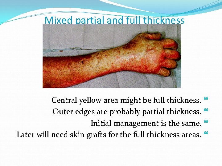 Mixed partial and full thickness Central yellow area might be full thickness. Outer edges