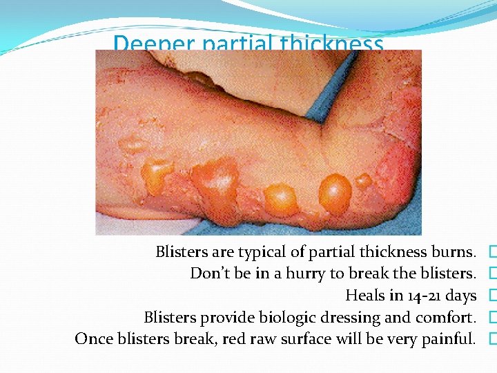 Deeper partial thickness Blisters are typical of partial thickness burns. Don’t be in a