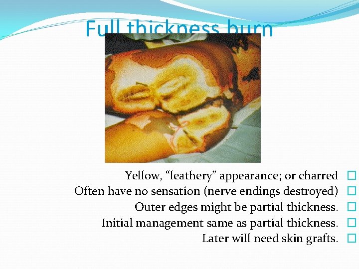 Full thickness burn Yellow, “leathery” appearance; or charred Often have no sensation (nerve endings