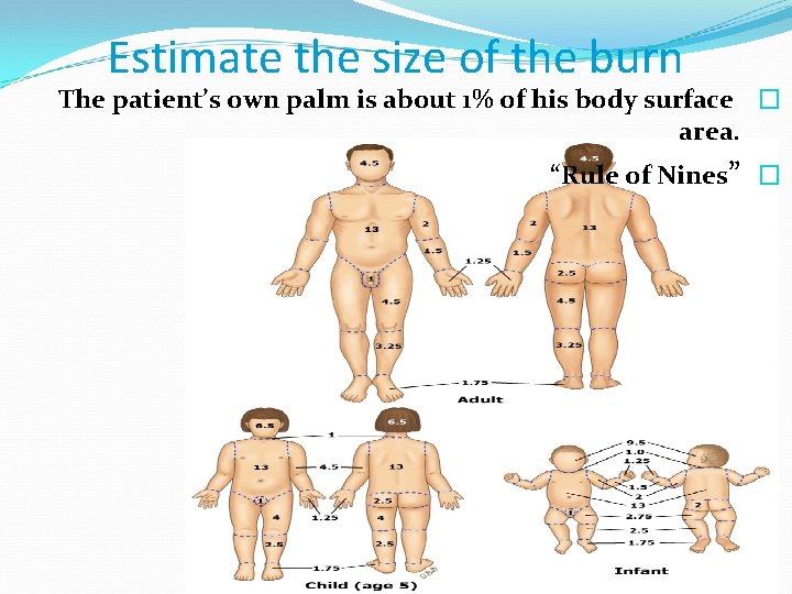 Estimate the size of the burn The patient’s own palm is about 1% of