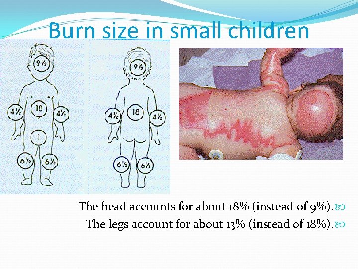 Burn size in small children The head accounts for about 18% (instead of 9%).