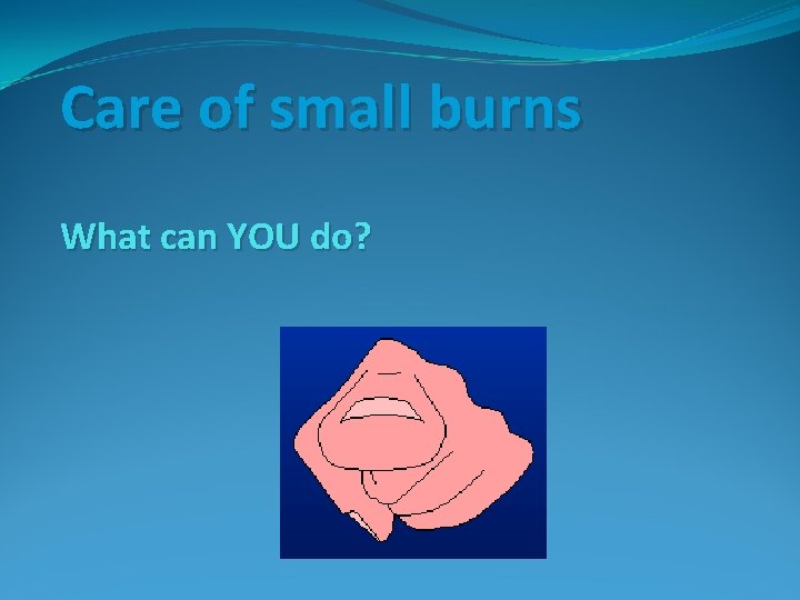 Care of small burns What can YOU do? 