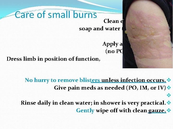 Care of small burns Clean entire limb with v soap and water (also under