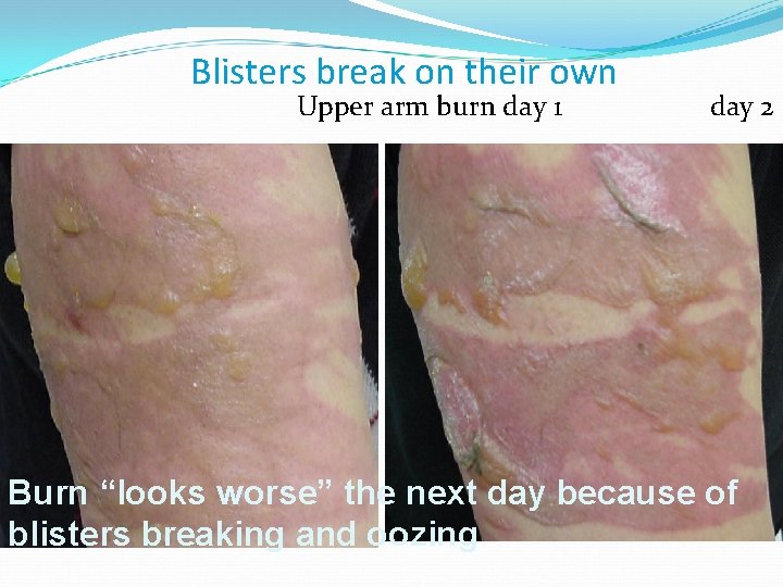 Blisters break on their own Upper arm burn day 1 day 2 Burn “looks