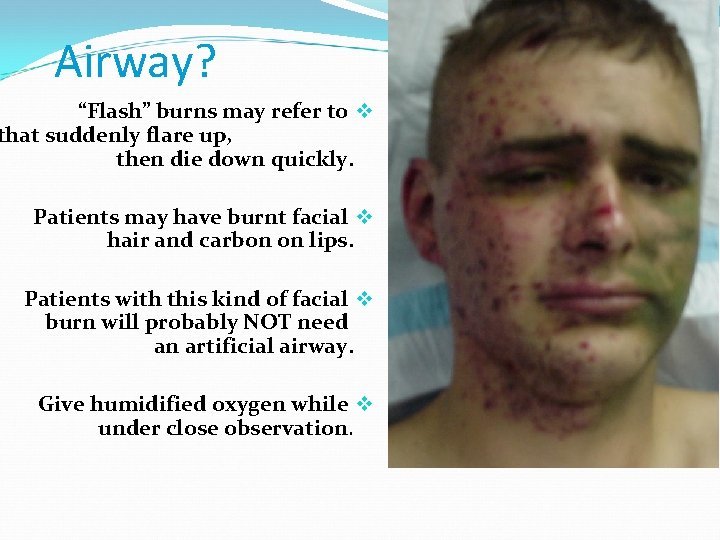 Airway? “Flash” burns may refer to v that suddenly flare up, then die down