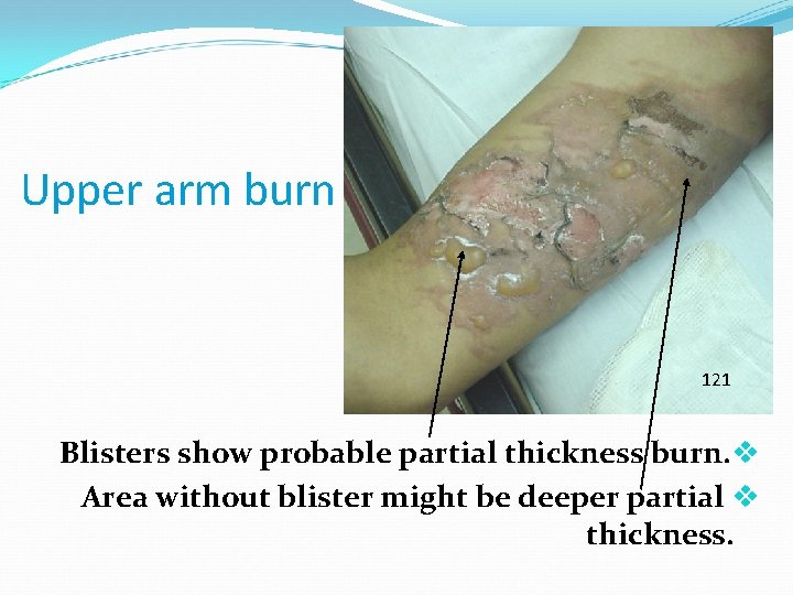 Upper arm burn 121 Blisters show probable partial thickness burn. v Area without blister