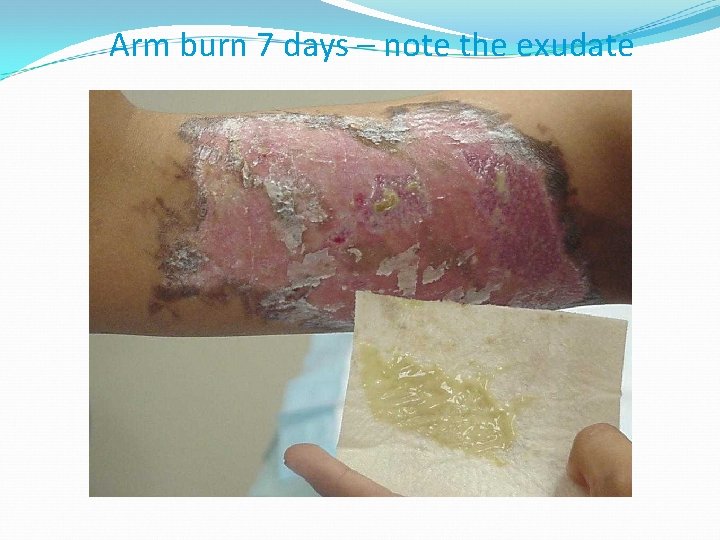 Arm burn 7 days – note the exudate 