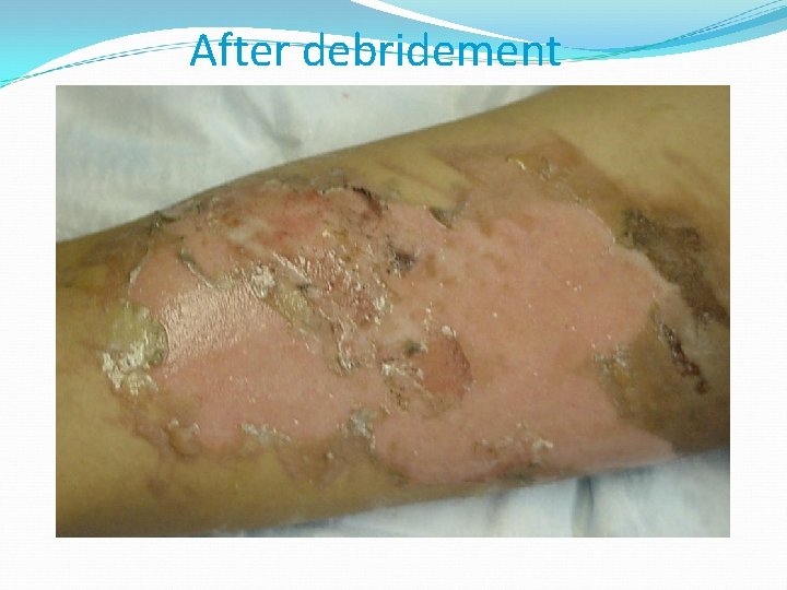 After debridement 