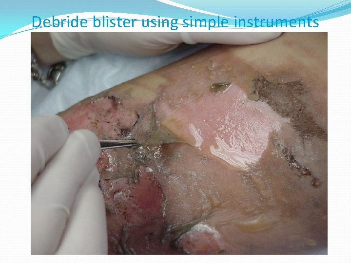 Debride blister using simple instruments 