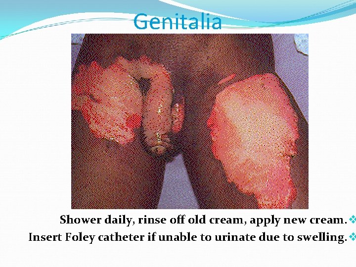 Genitalia Shower daily, rinse off old cream, apply new cream. v Insert Foley catheter