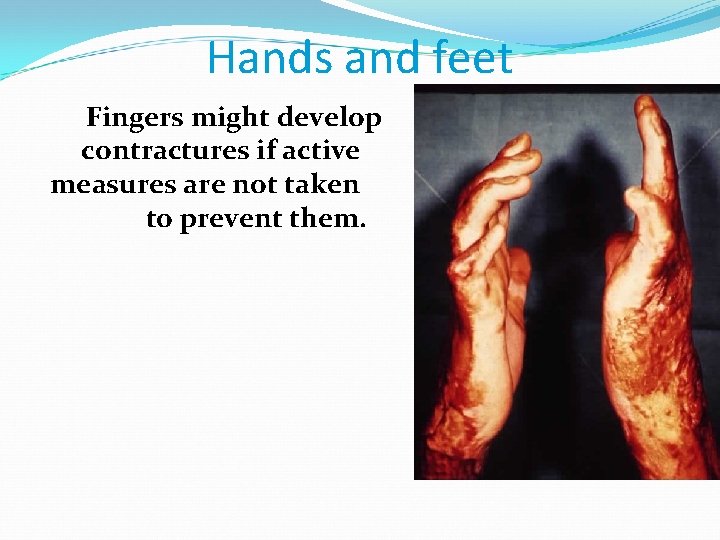 Hands and feet Fingers might develop contractures if active measures are not taken to