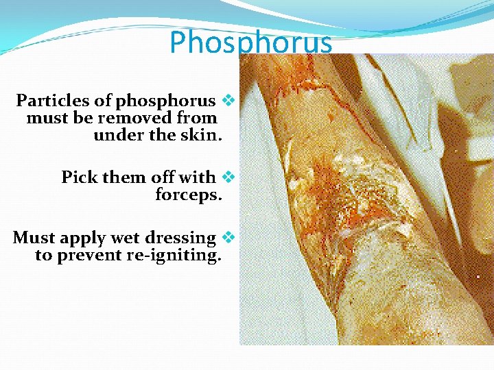 Phosphorus Particles of phosphorus v must be removed from under the skin. Pick them