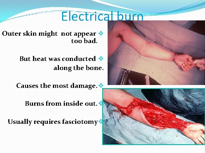 Electrical burn Outer skin might not appear v too bad. But heat was conducted