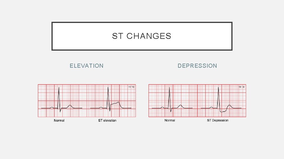 ST CHANGES ELEVATION DEPRESSION 