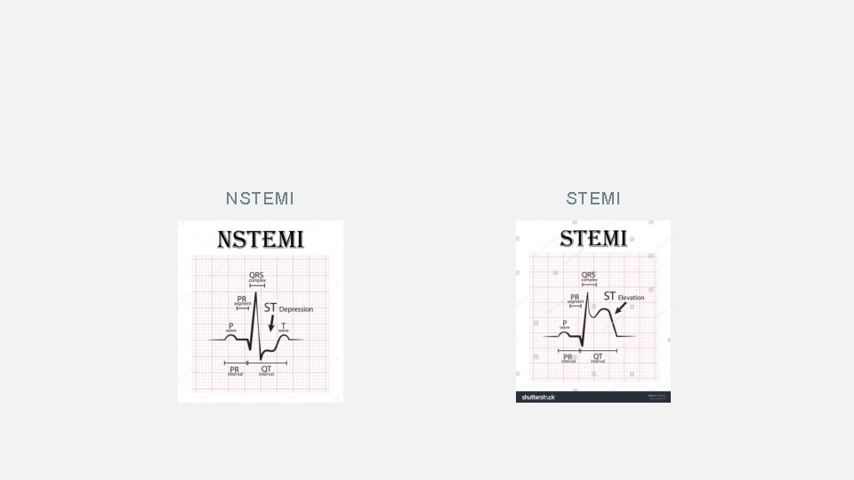 NSTEMI 
