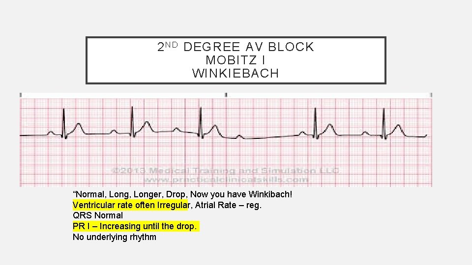 2 N D DEGREE AV BLOCK MOBITZ I WINKIEBACH “Normal, Longer, Drop, Now you
