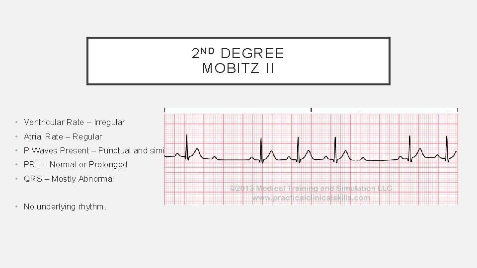 2 N D DEGREE MOBITZ II • Ventricular Rate – Irregular • Atrial Rate