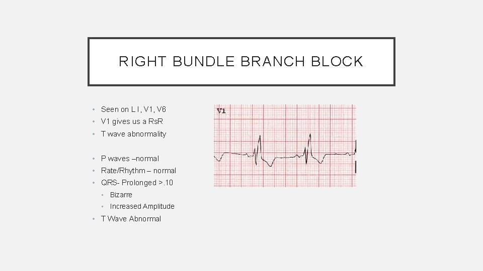 RIGHT BUNDLE BRANCH BLOCK • Seen on L I, V 1, V 6 •