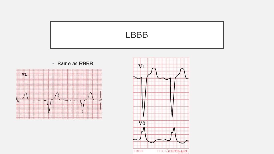 LBBB • Same as RBBB 