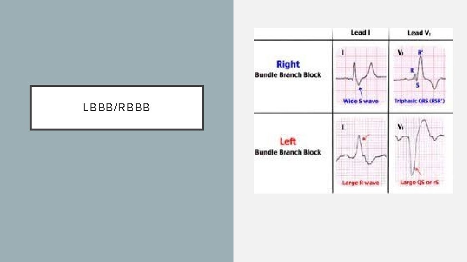 LBBB/RBBB 