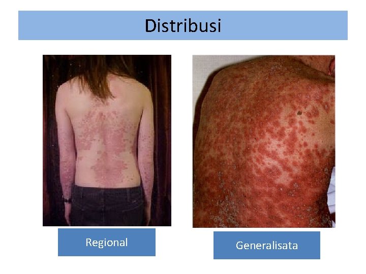Distribusi Regional Generalisata 