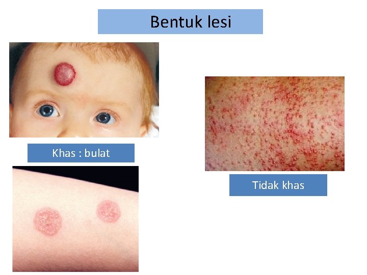 Bentuk lesi Khas : bulat Tidak khas 