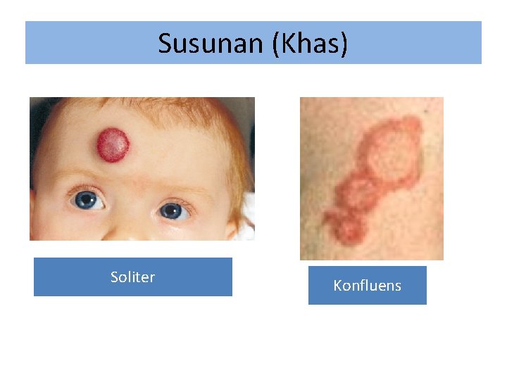 Susunan (Khas) Soliter Konfluens 