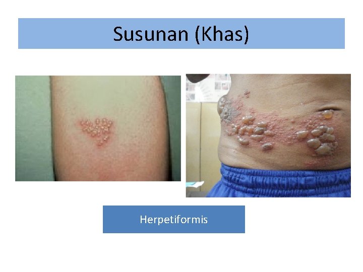 Susunan (Khas) Herpetiformis 